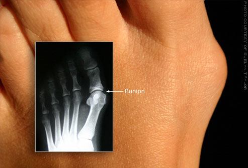 Bone Problems with Bunions