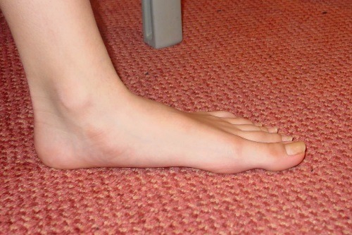 Flat Feet on the ground