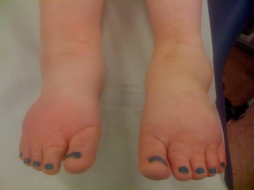 Feet with Lymphedema