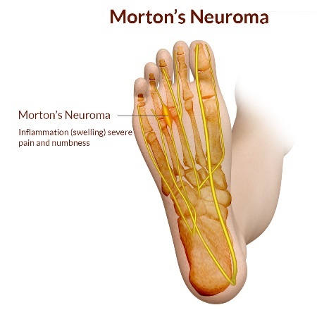 Mortons Neuroma Pain