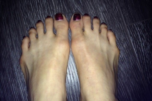 Taylors Bunions on toes