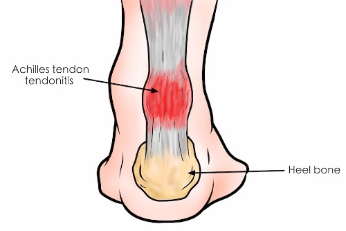 achilles tendon shown
