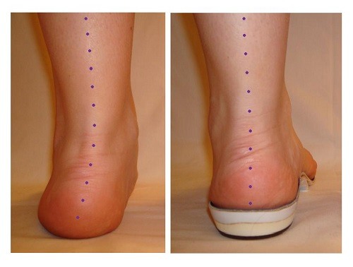 difference in pronation with and without orthotic