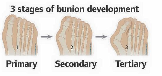 Bunion Progression on foot