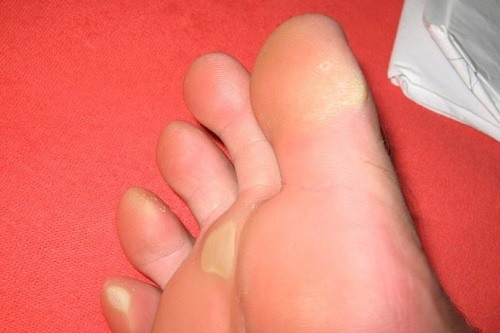 Calluses on a Foot 