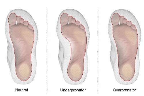 Foot Pronator Bunion Causes