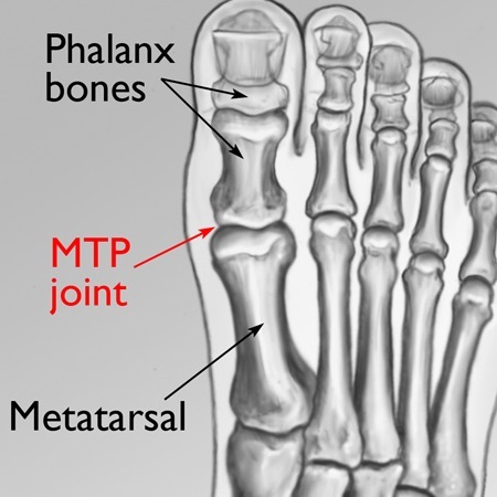 MTP Joint Inflamation