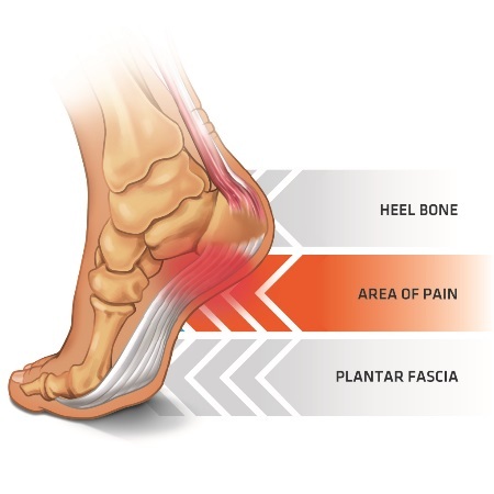 Plantar Fasciitis Area of Pain On The Foot